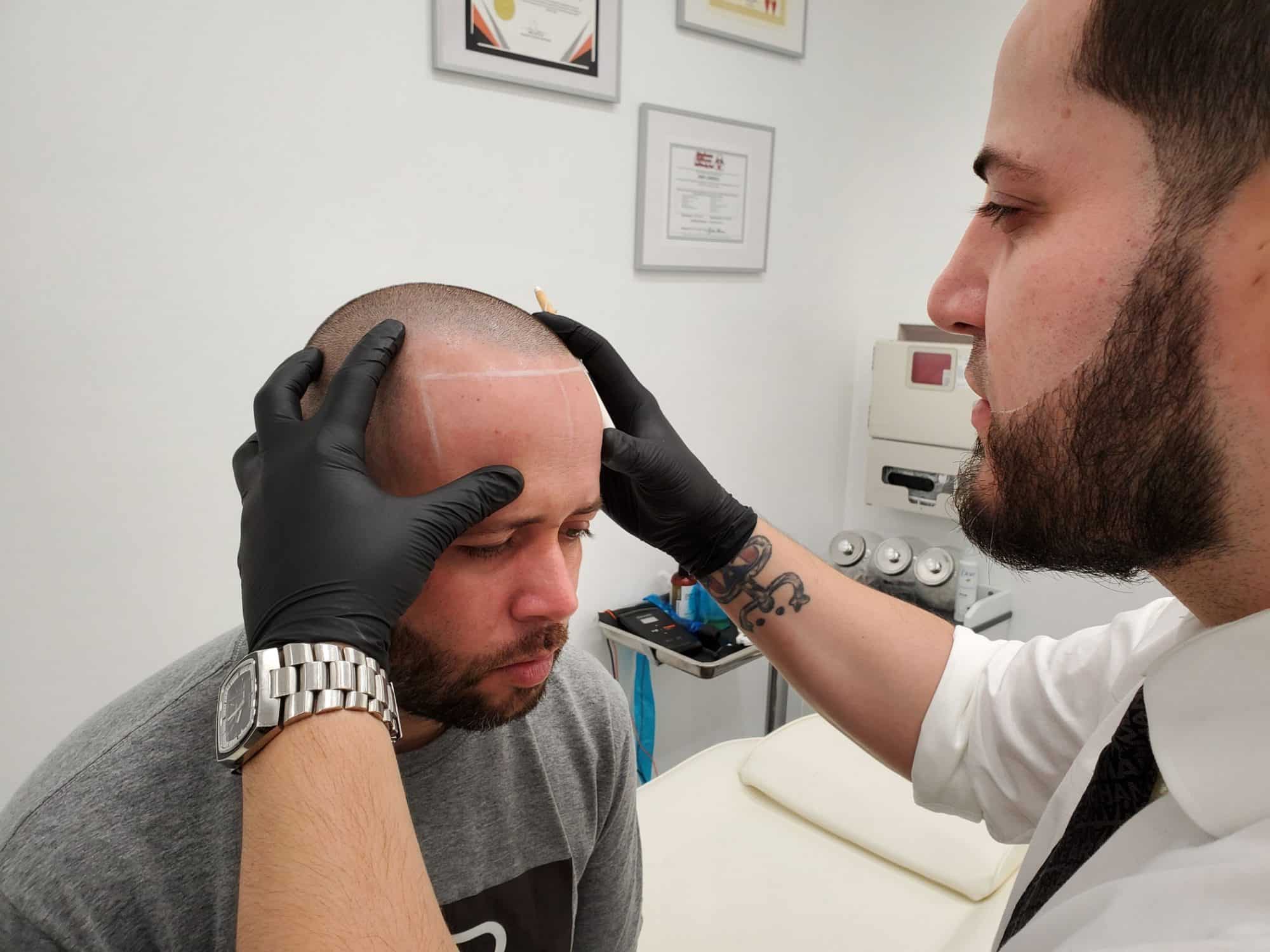 Erik Lorenzo marking a client's hairline outline for scalp micropigmentation