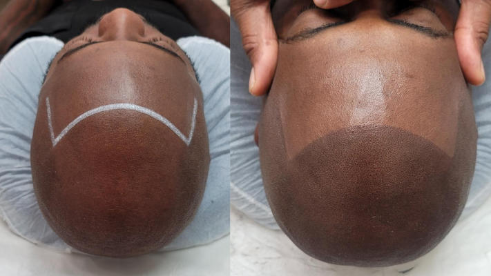 Before and after scalp micropigmentation hairline design on a client with dark skin tone