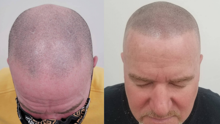 Before and after scalp micropigmentation for a receding hairline, front view
