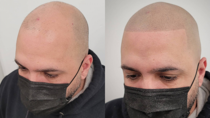 Before and after scalp micropigmentation on a fully bald head, side profile