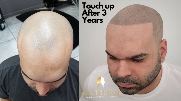 Scalp micropigmentation touch-up results after 3 years, Artisan Scalp Micropigmentation client