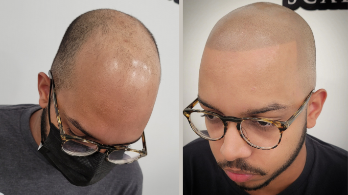 Before and after scalp micropigmentation on a bald head, side angle