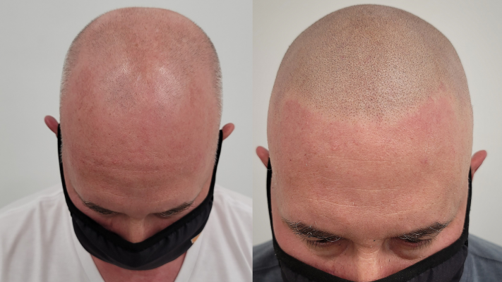 Before and after scalp micropigmentation hairline density, front view