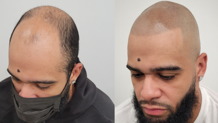 Before and after scalp micropigmentation for a receding hairline with beard