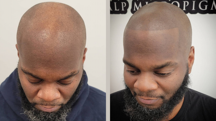Before and after scalp micropigmentation on a fully bald head at Artisan Scalp Micropigmentation studio