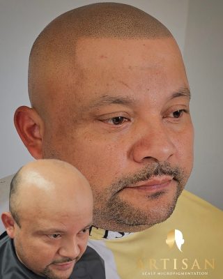 Before and after scalp micropigmentation on a shaved head, Artisan Scalp Micropigmentation client