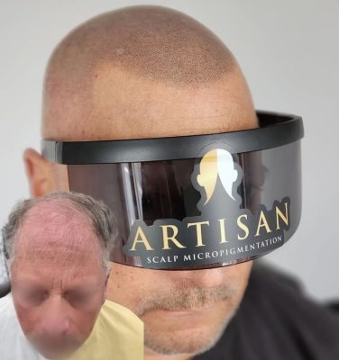 Artisan Scalp Micropigmentation client before and after result